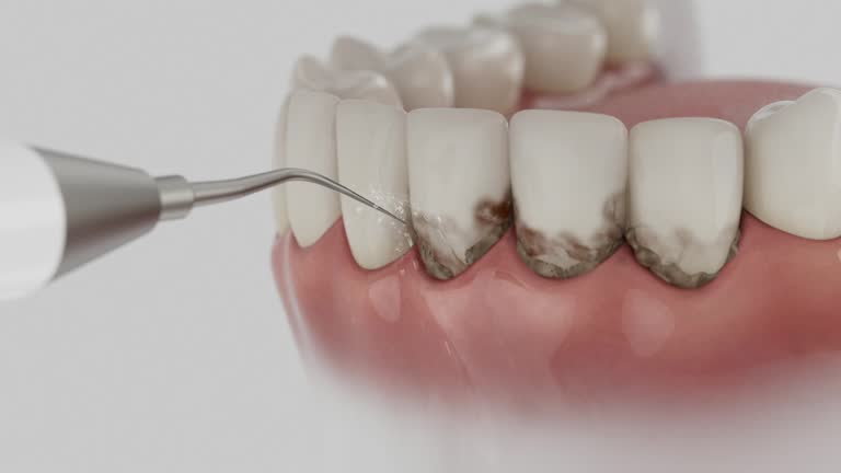 Trusted Wisdom Tooth Removal service in North Barrington, IL - Dentist Open Now